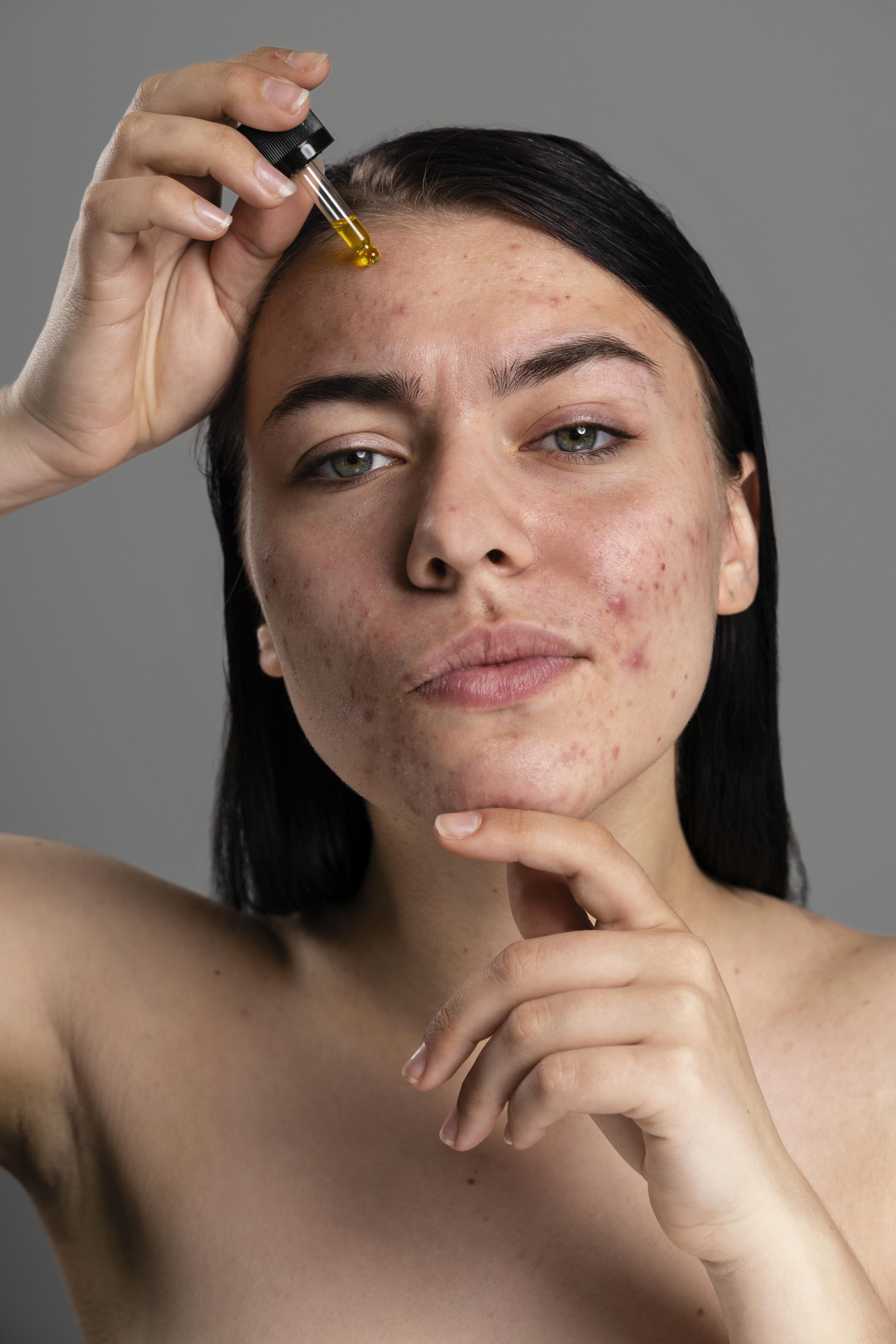 portrait-young-woman-being-confident-with-acne